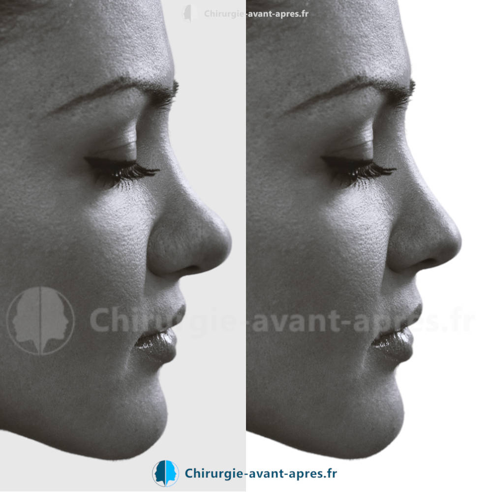 rhinoplastie Lille avant apres