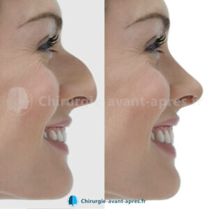 rhinoplastie Lyon avant apres