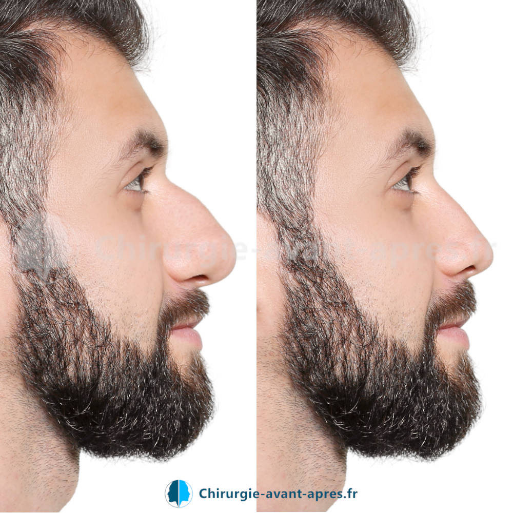 rhinoplastie Marseille