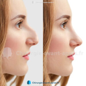 rhinoplastie Montpellier avant apres