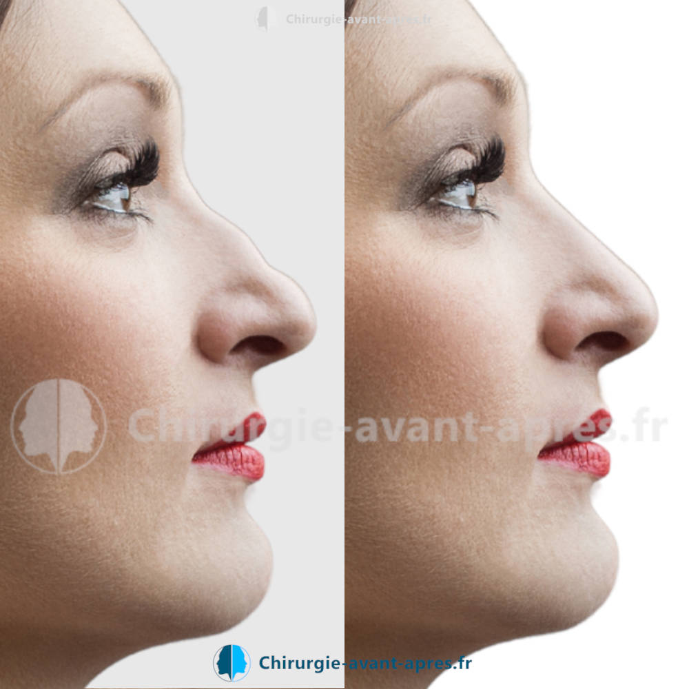 rhinoplastie Nantes avant apres