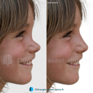 rhinoplastie Rennes avant apres