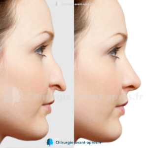 rhinoplastie Strasbourg avant apres