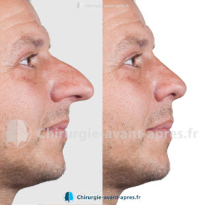 rhinoplastie Toulon avant apres