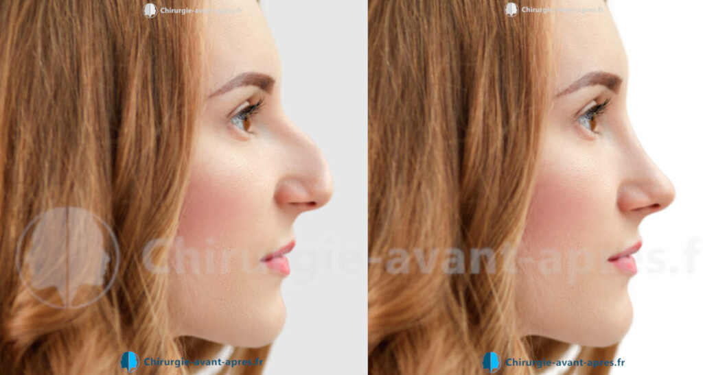 rhinoplastie a Montpellier