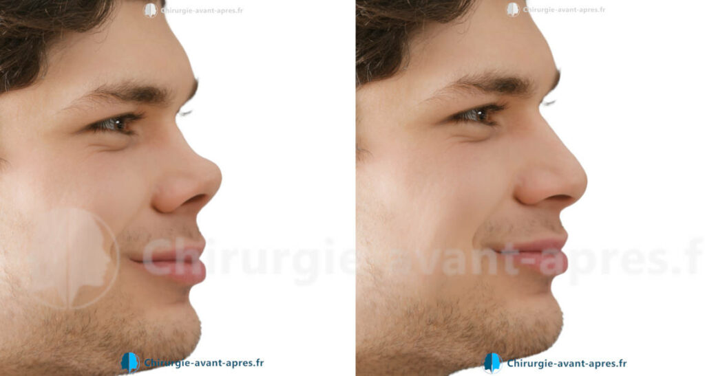 rhinoplastie a Reims