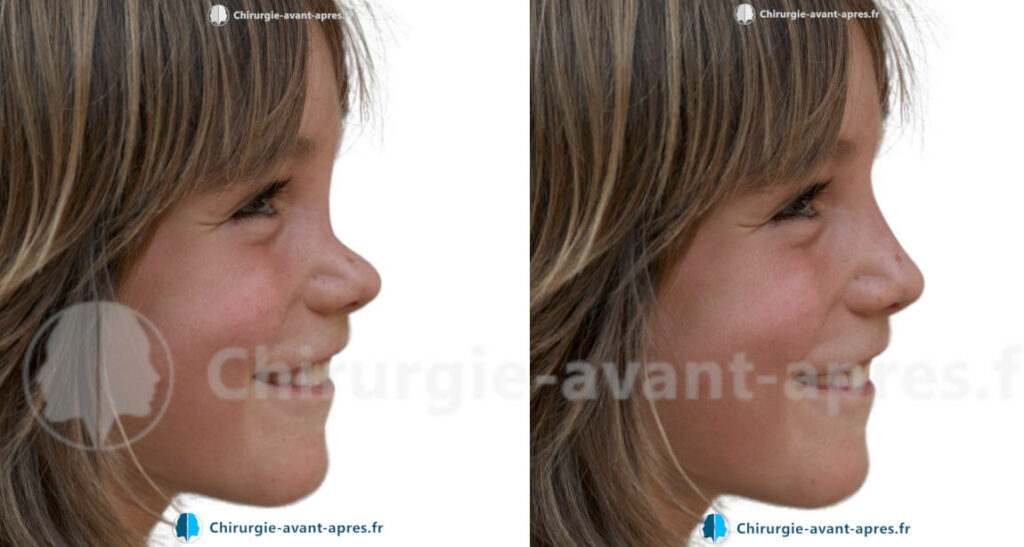 rhinoplastie a Rennes