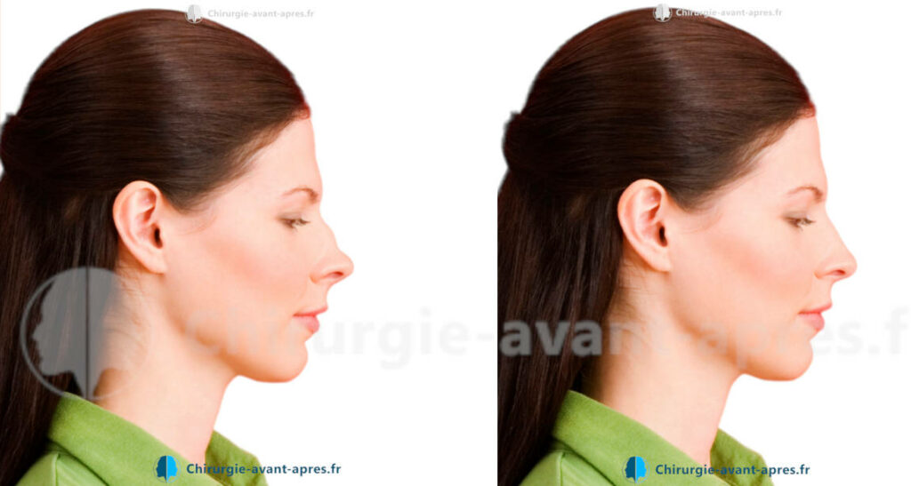 rhinoplastie a bordeaux