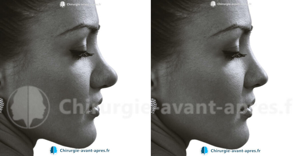 rhinoplastie a lille