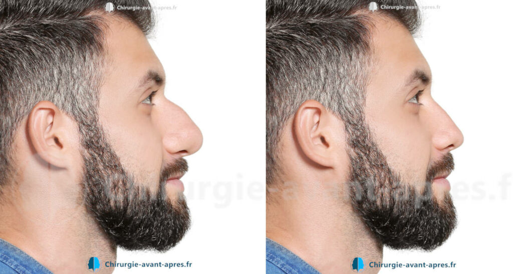 rhinoplastie a marseille