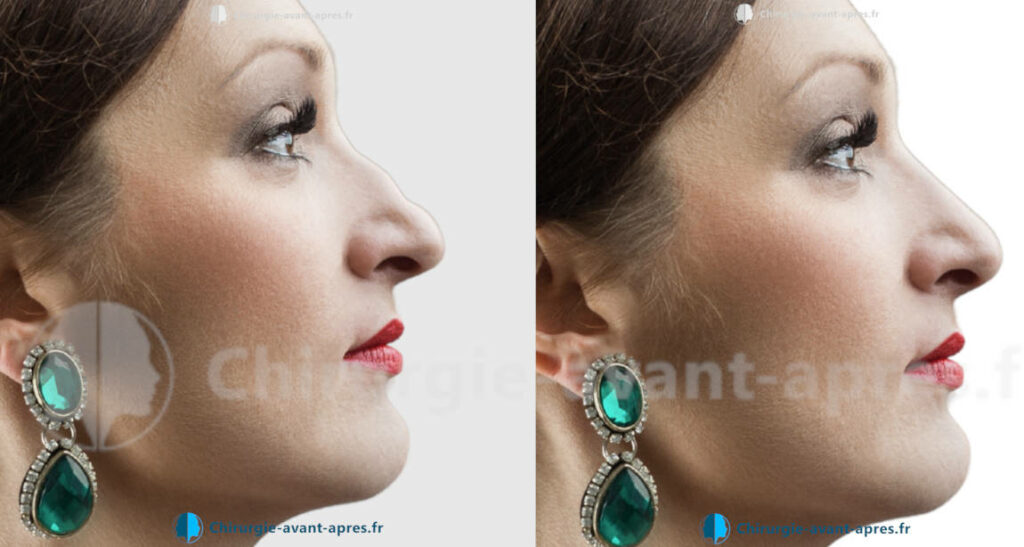 rhinoplastie a nantes