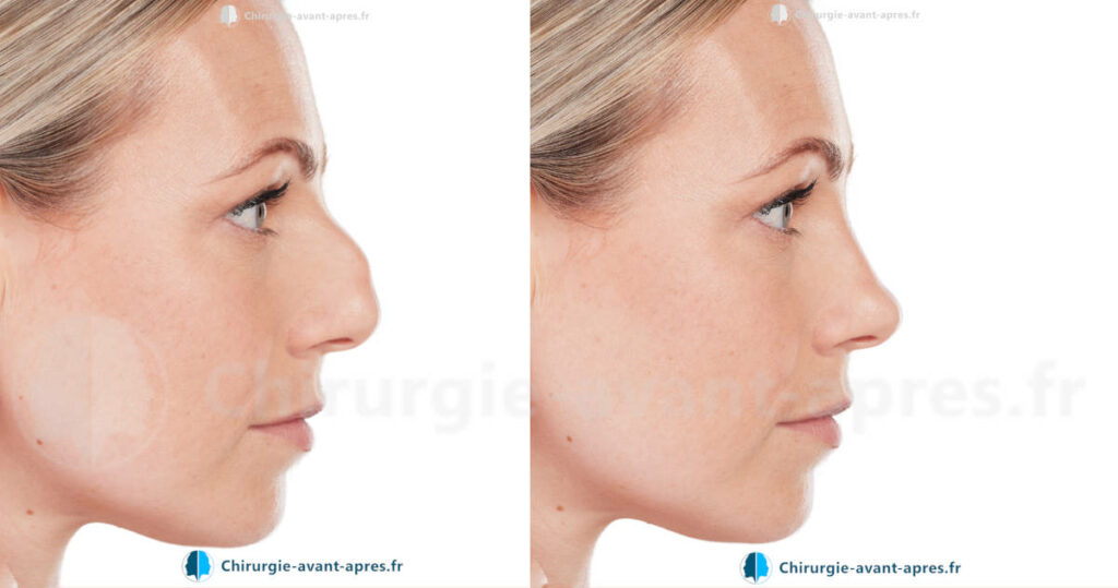 rhinoplastie a paris