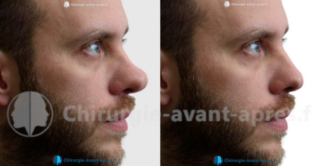 rhinoplastie a saint etienne