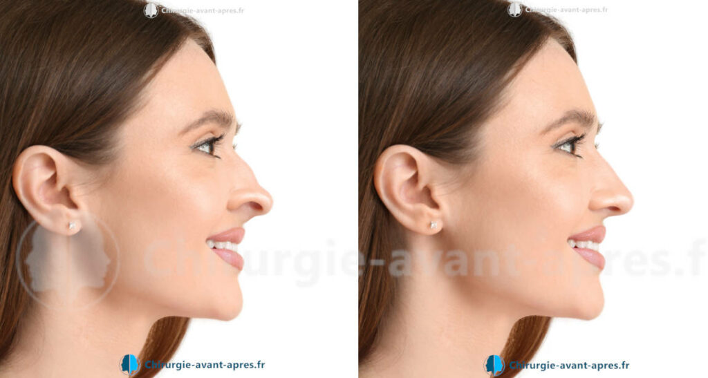 rhinoplastie a toulouse
