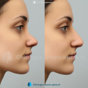 rhinoplastie cloisons résultat