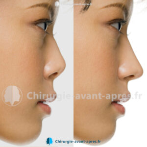 rhinoplastie dijon avant apres