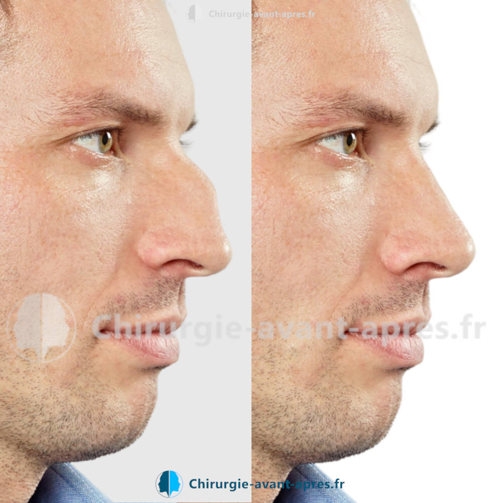 rhinoplastie le havre avant apres