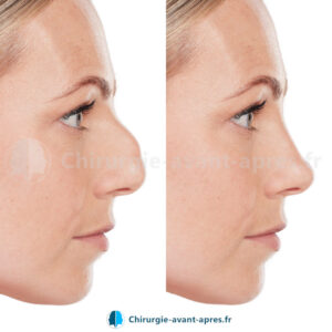rhinoplastie paris avant apres